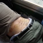akupunktur in china rückenschmerzen