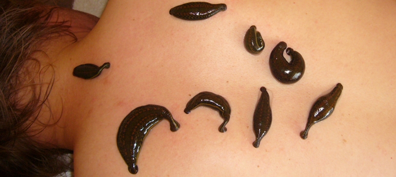 Blutegeltherapie bei Rückenschmerzen